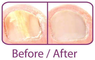 NAILCLIN AntiFungal Treatment 4ml
